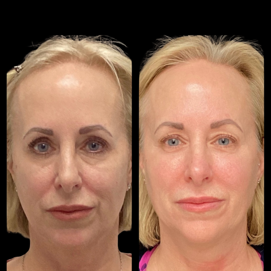 Restylane treatment and aesthetic consultation
