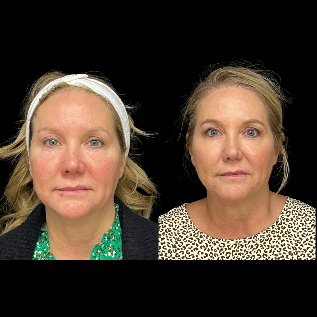 PDO thread treatment illustration