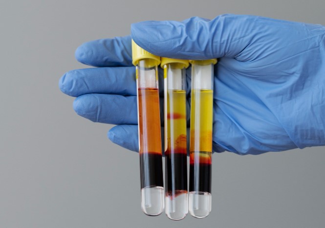 Platelet-rich plasma preparation for hair restoration